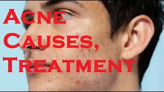 Acne Causes Treatment [upl. by Karina768]