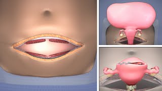 Abdominal Myomectomy through Maylard incision  TVASurg [upl. by Nwahser638]