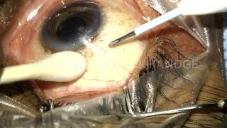 Ozurdex implant intravitreal injection technique [upl. by Aneelas]