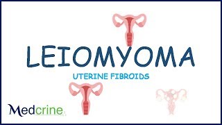 Uterine Fibroids Leiomyomas [upl. by Landry1]