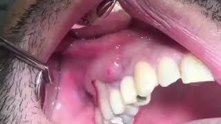 Popping a Tooth Abscess [upl. by Lrat]