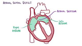 Atrial septal defect causes symptoms diagnosis treatment pathology [upl. by Ebbie]