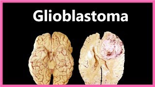 Glioblastoma Multiforme – Symptoms Diagnosis and Treatment ✔ [upl. by Eerrehc]