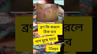 ব্রণ আছে দাগ মোছার সহজ উপায় sscgdmedical agniveer acene pimples skincare youtubeshorts [upl. by Bluma154]