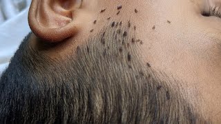 How to get rid hundred lice from short hair  Remove all big lice from black hair [upl. by Island]