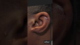 What is the Treatment for Keloid Keloid Removal Surgery in Delhi  Dr PK Talwar [upl. by Antonino240]