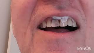 How to fix a chipped front tooth [upl. by Lodie]