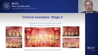 Assessing periodontitis clinical examples amp key points  tutorial by Mariano Sanz [upl. by Gifferd]