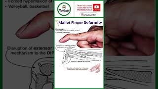 Mallet finger ddeformity [upl. by Anthiathia508]