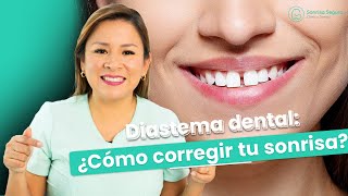 Diastema dental Como corregir tu sonrisa [upl. by Mitinger]