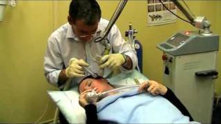 Dr Bruce Williamson CO2 Laser Demonstration to Slow Aging for Skin [upl. by Pauwles]