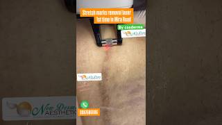 Stretch marks treatment Newderma Aesthetic clinic Mira Road cosderma dermatologist best skin clinic [upl. by Malti]