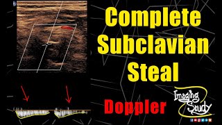 Complete Subclavian Steal  Ultrasound  Doppler  Case 242 [upl. by Cerelia]