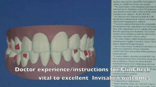 Invisalign ClinCheck Explanation [upl. by Zetrok]