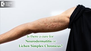 What is Neurodermatitis Causes Symptoms Diagnosis Treatment  Dr Aruna Prasad [upl. by Gerbold]