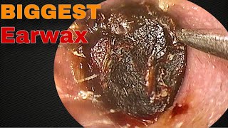 BIGGEST Earwax Difficult Removal EP 10  Doctor Anh [upl. by Richy]