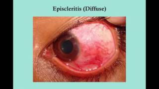 Scleritis and Episcleritis CRASH USMLE Step 2 and 3 [upl. by Drahsar788]