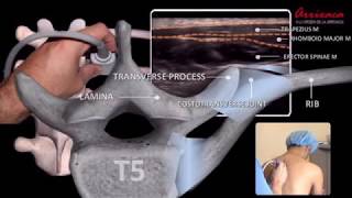 The ESP erector spinae plane Block  Our Current Understanding [upl. by Johannes]