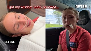 I GOT MY WISDOM TEETH REMOVED hilarious [upl. by Atidnan]