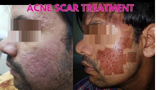 Laser acne scar removal  Before and after results  Laser treatment for scars [upl. by Down]