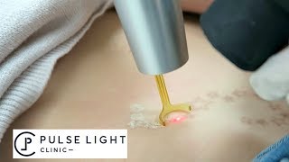 The TRUTH About Tattoo Removal My Experience  Tips  Pulse Light Clinic [upl. by Rupert]