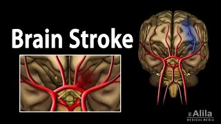 Brain Stroke Types of Causes Pathology Symptoms Treatment and Prevention Animation [upl. by Huxley617]