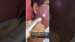 Birthmark removal Nevus of Ota By Q switch NdYAG laser ✅ [upl. by Pepi103]