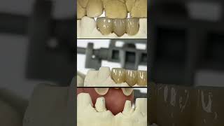 Missing Tooth Restoration  Zirconium bridge shorts dentist youtubeshorts [upl. by Caasi]