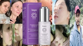 Kaya Salicylic Acid Serum  Honest Review [upl. by Asiilanna]