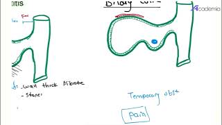 chronic cholecystitis and biliary colic [upl. by Greyson]