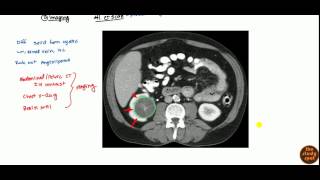 Renal Cell Carcinoma for USMLE [upl. by Christi]