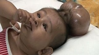 Baby Born With Two Heads  Extraordinary Birth [upl. by Swarts973]