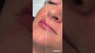 Lips Filler Transformation  NaturalLooking Results  Dubais Top Aesthetic Clinic [upl. by Pathe]