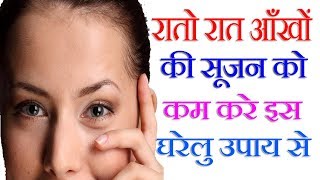 रातो रात आँखों की सूजन को कम करे इस घरेलु उपाय से  Swollen Eyelid Treatment [upl. by Attenehs132]