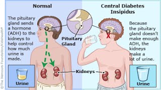 Central Diabetes Insipidus [upl. by Sheffield]