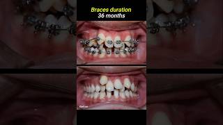 Braces for crowded teeth braces orthodontist dentistry dentist [upl. by Pirnot961]