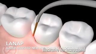 How Does Laser Surgery Work Treat Gum Disease  LANAP [upl. by Nahij]