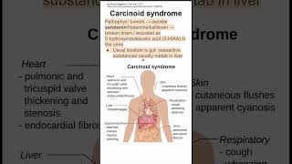 Carcinoid syndrome [upl. by Urissa]