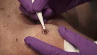 Watch amp Learn Electrosurgery [upl. by Galer]