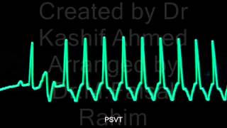 Paroxysmal Supra Ventricular Tachycardia by Dr MFaisal Rahim and Dr Kashif Ahm [upl. by Birecree329]