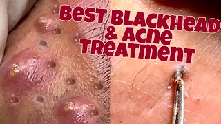 Acne removal tiktok  blackhead removal tiktok 15 [upl. by Llenna263]