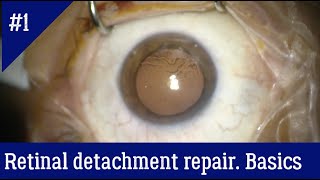 The general principles of vitrectomy for retinal detachment repair [upl. by Eidassac]