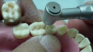 تريكات ال cavity preparation وازاى تجهز كلاس ٢ بكل سهولهClass II amalgam preparation [upl. by Hilton]