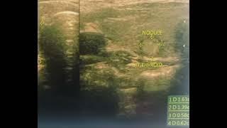 Thyroid Nodule DrMekhalaSarkar [upl. by Lindblad]