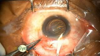 Learn Step by step small incision cataract surgery scleral tunnel [upl. by Anialed319]