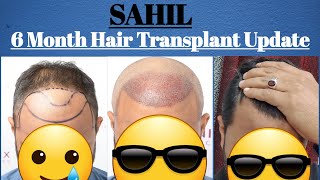 SAHIL  Six Month Hair Transplant Result Update  Best Hair Transplant Result 2022  CASE STUDY [upl. by Papagena677]