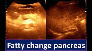 Moderately diffuse fatty infiltration of the Liver  Fatty change pancreas [upl. by Reilamag]