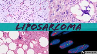 Liposarcoma 101 Everything a Pathologist Needs to Know [upl. by Eseilanna35]