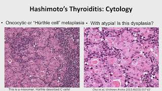 2023 Classic Lectures in Pathology What You Need to Know Endocrine Pathology [upl. by Tisdale]