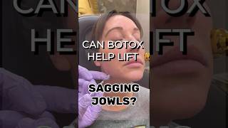 The use of Botox to treat sagging jowls saggyjowls jowls aesthetics agelessbeauty antiaging [upl. by Seidel204]